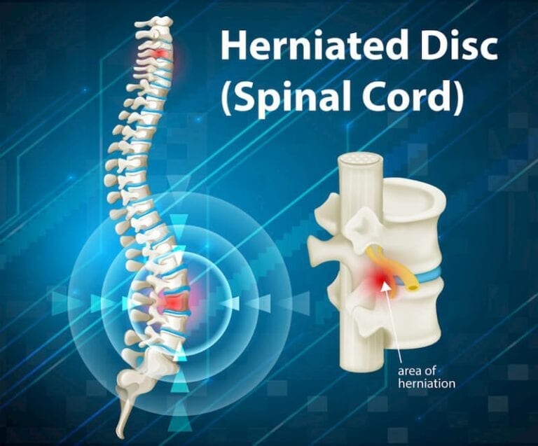 herniated disc graphic